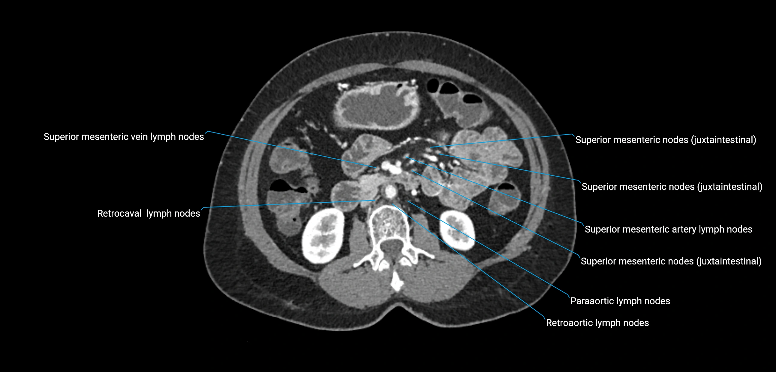 CT ct abdominal lymph nodes  axial cross sectional anatomy  enchanced radiology image -img-00002-00201.webp